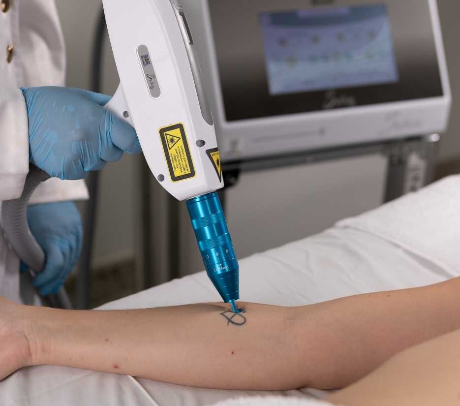 Syrius Yag Laser Nd:Yag Q-Switched removendo tatuagem com desenho de coração