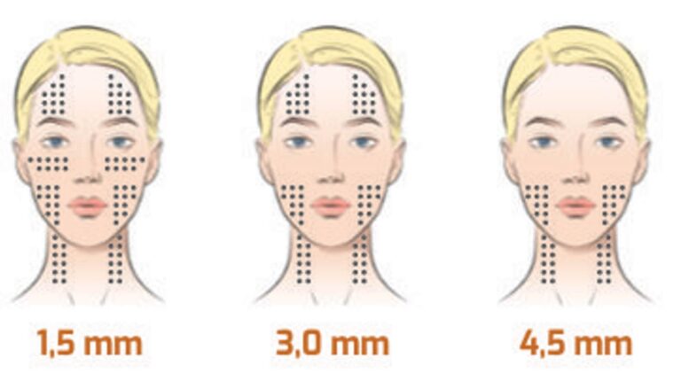Ultrassom Microfocado de Estética - Visage