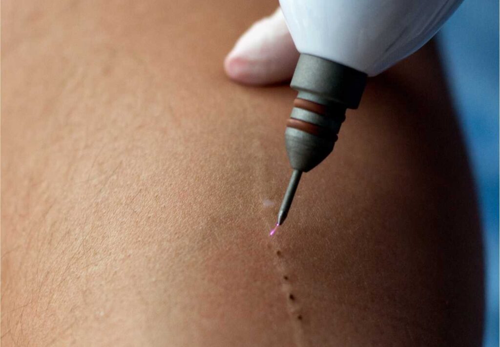 Jato de plasma sendo utilizado para melhora da aparência da cicatriz - foi utilizado a técnica de fulguração