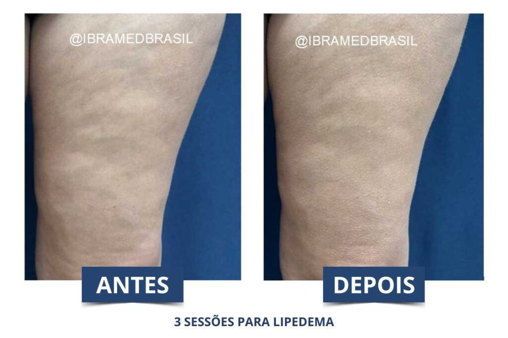 Pressoterapia para Lipedema - Antes e depois utilizando o Pressury da IBRAMED
