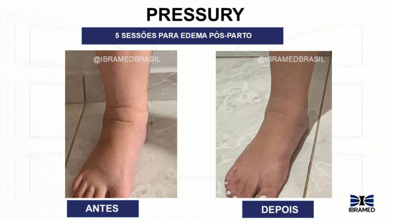 Pressoterapia Antes e depois no Pós-parto