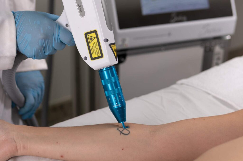 Syrius Yag Laser Nd:Yag Q-Switched removendo tatuagem com desenho de coração