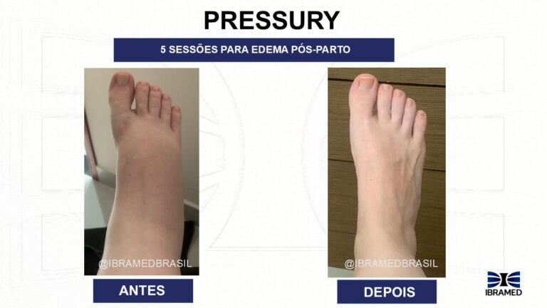 Pressoterapia Antes e depois no Pós-parto