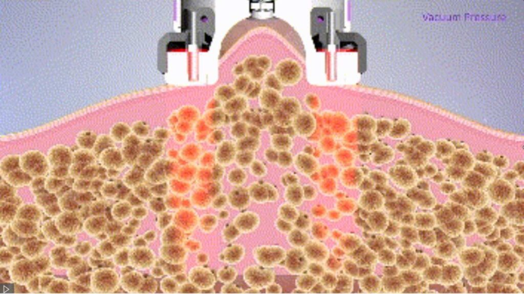 Radiofrequência com Vácuo - O que é e como funciona?