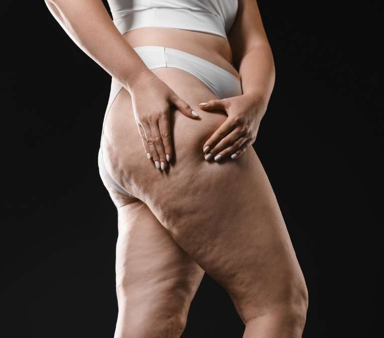 Junho, mês de conscientização do lipedema
