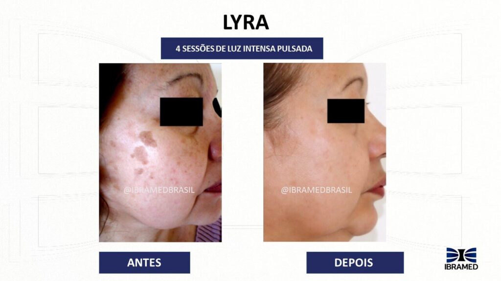 Lyra Ibramed Luz Intensa Pulsada antes e depois