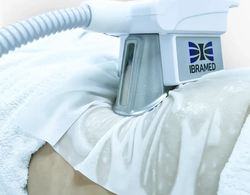 criolipolise-de-succao-ibramed-modelagem-corporal.webp